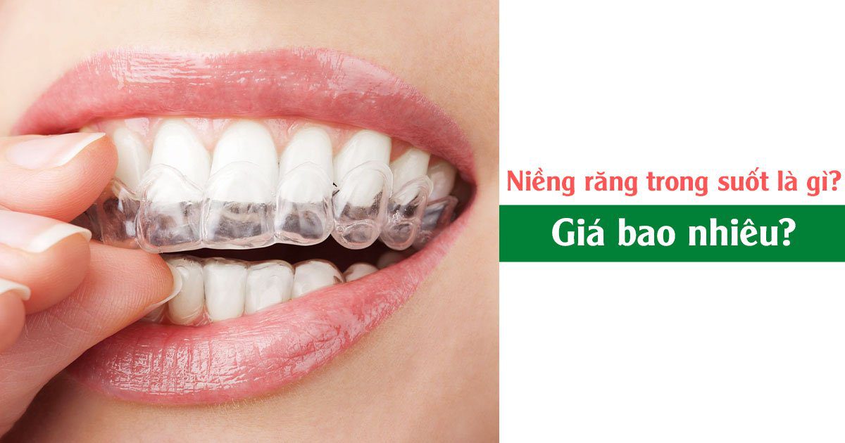 Niềng răng trong suốt là gì?