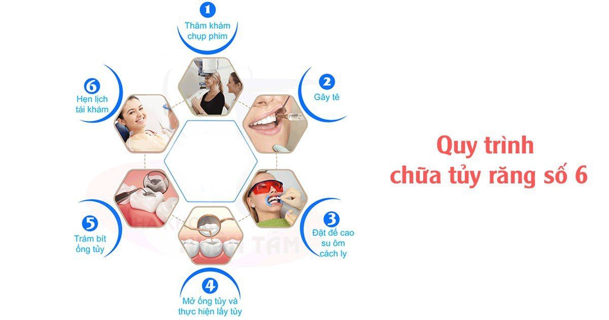 Quy trình chữa tủy răng số 6