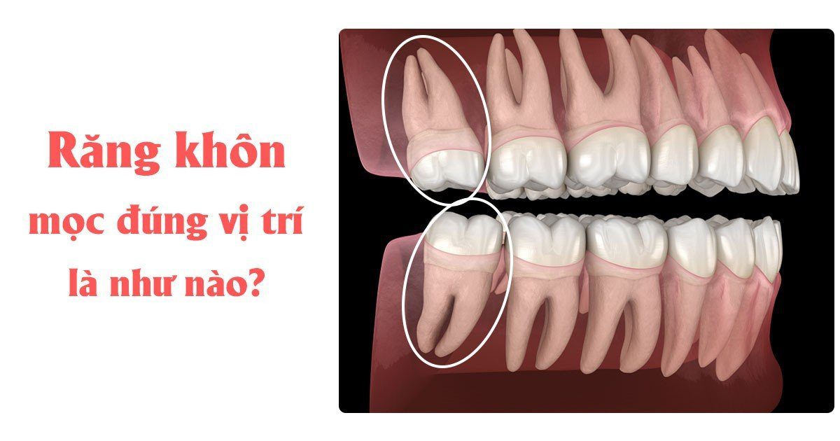 Răng khôn mọc đúng vị trí là như nào?