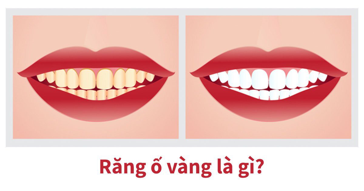 Răng ố vàng là gì?