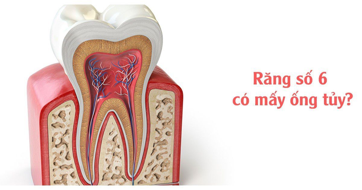 Răng số 6 có mấy ống tủy?