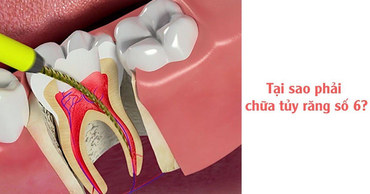 Tại sao phải chữa tủy răng số 6?