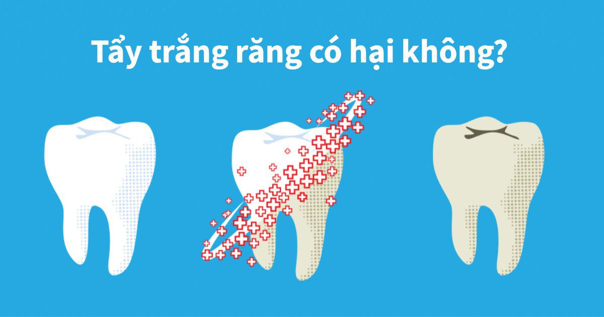 Tẩy trắng răng có hại không?