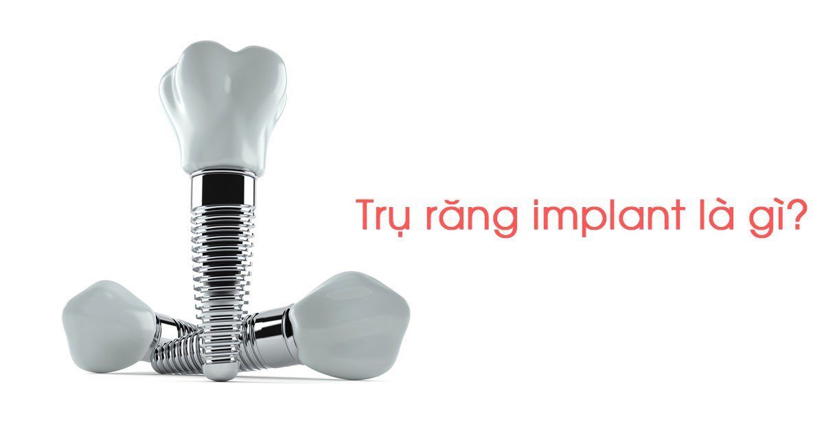 Trụ răng implant là gì?