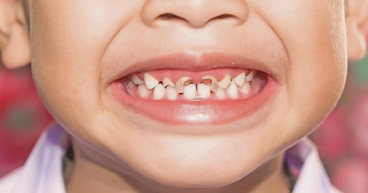 Trẻ bị con sâu răng làm đau răng