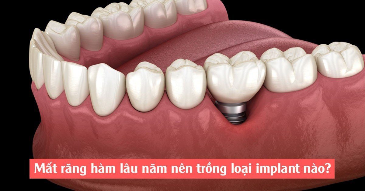 Mất răng hàm lâu năm nên trồng loại implant nào?