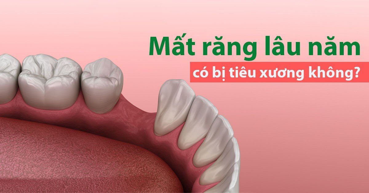 Mất răng lâu năm có bị tiêu xương không?
