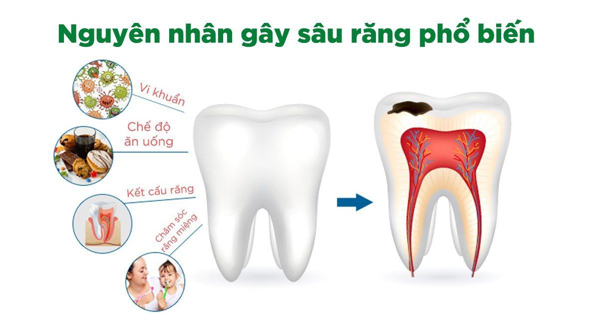 Nguyên nhân gây sâu răng phổ biến