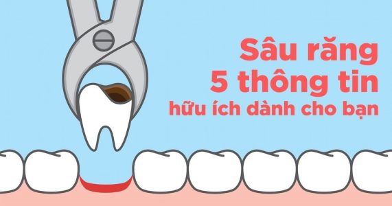 Sâu răng - 5 thông tin hữu ích dành cho bạn