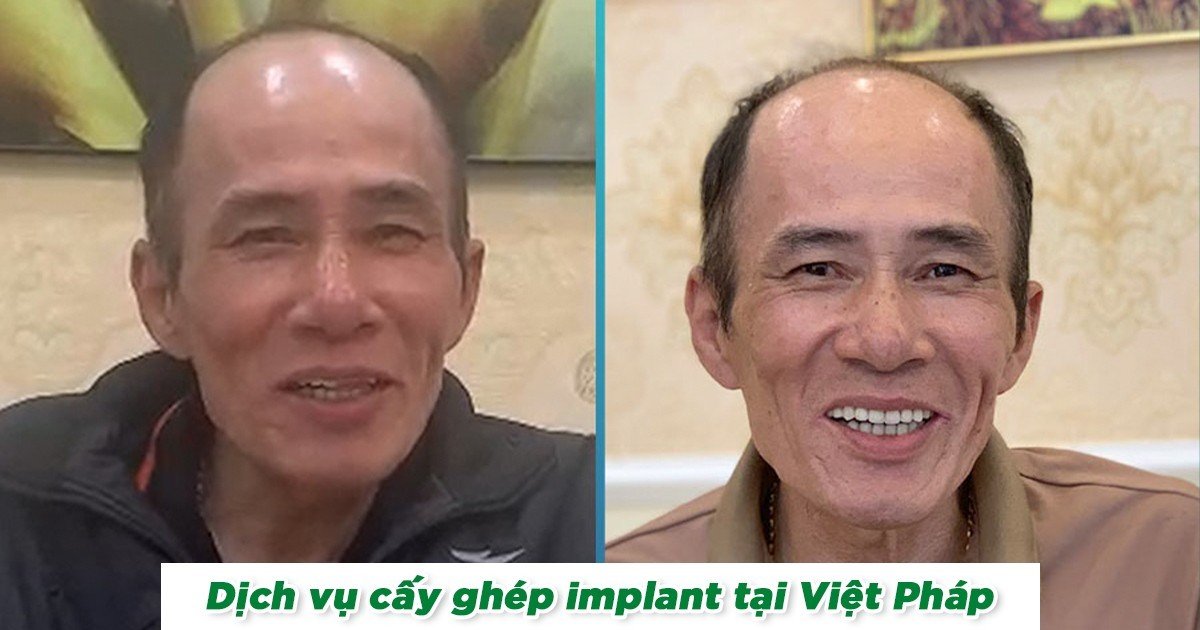 Cắm implant khôi phục răng bị mất