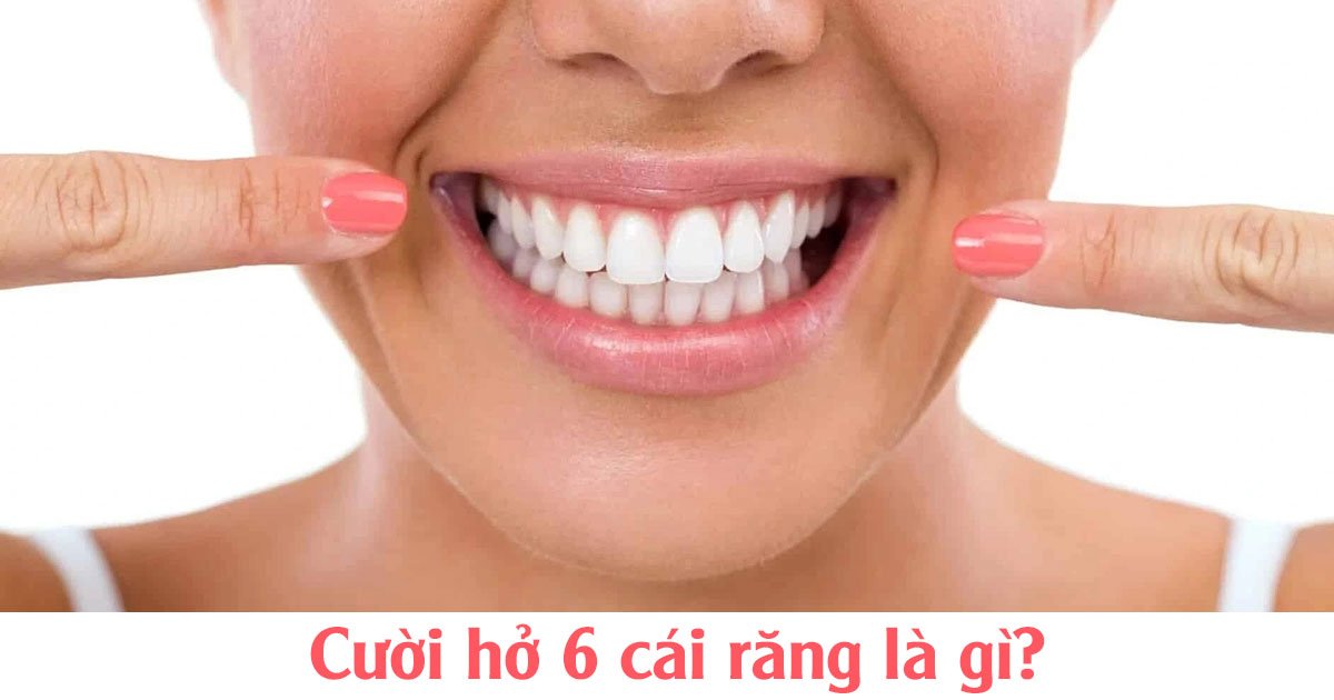 Cười hở 6 cái răng là gì?