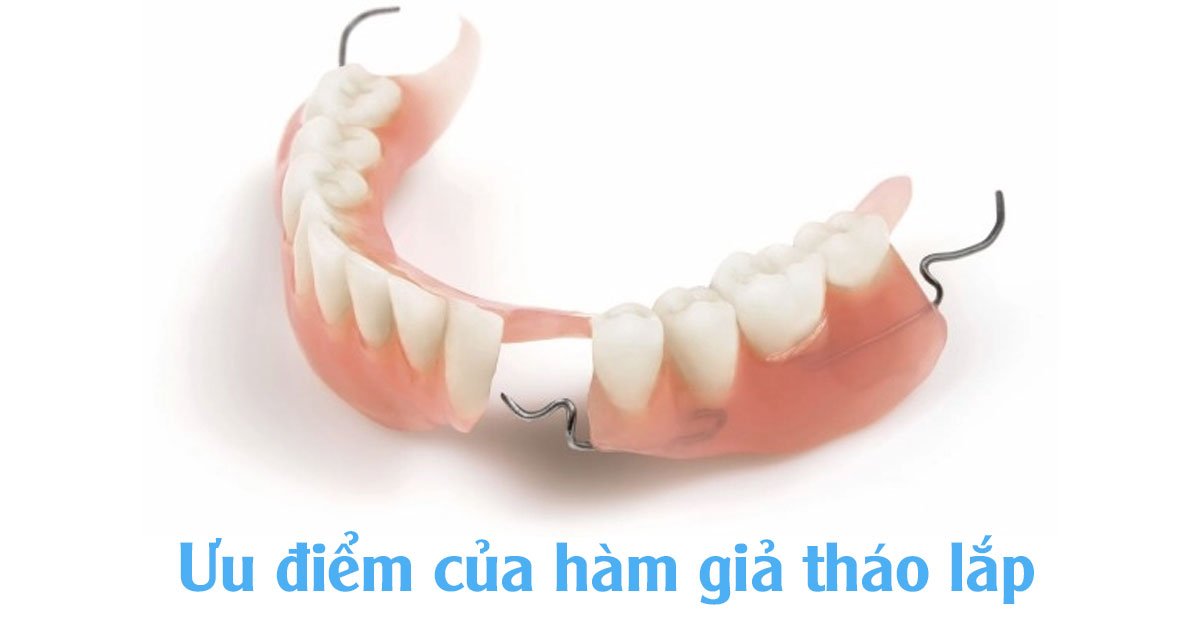 Ưu điểm của hàm răng giả tháo lắp